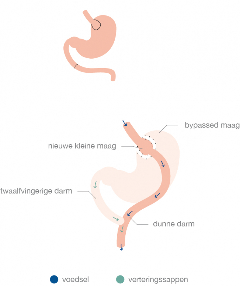 Gastric Bypass Of Maagoverbrugging Obesitaskliniek Tielt Heelkunde Tielt